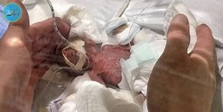 کوچک‌ترین نوزاد پسر دنیا زنده ماند+تصاویر