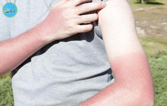 مشکلات پوستی در فصل گرما + درمان‌های طبیعی