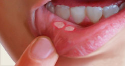 درمان فوری آفت دهان با ۷ فرمول طبیعی