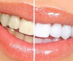 سفید کردن دندان در خانه با روش های ساده