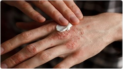 ۶ راهکار ساده برای درمان اگزما پوستی