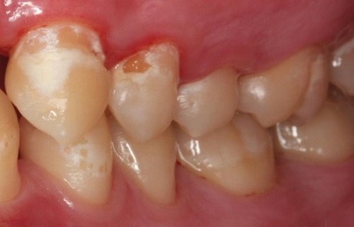 ۱۰ ماده غذایی که دندان‌هایتان را نابود می‌کند