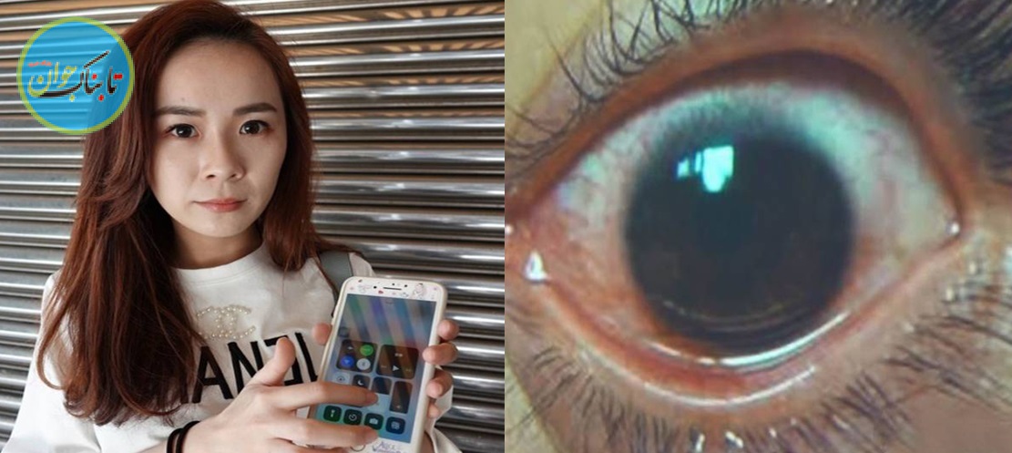 پخته شدن چشم دختر جوان با نور موبایل + عکس
