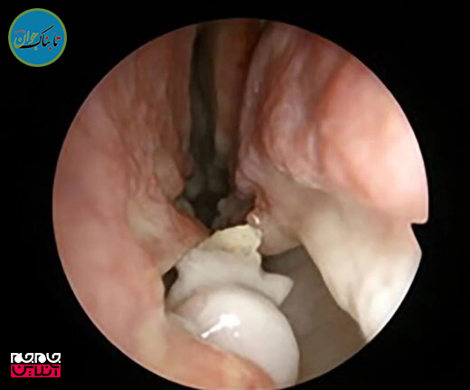 دماغ یک مرد دانمارکی دندان درآورد! (+تصاویر)