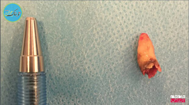 دماغ یک مرد دانمارکی دندان درآورد! (+تصاویر)