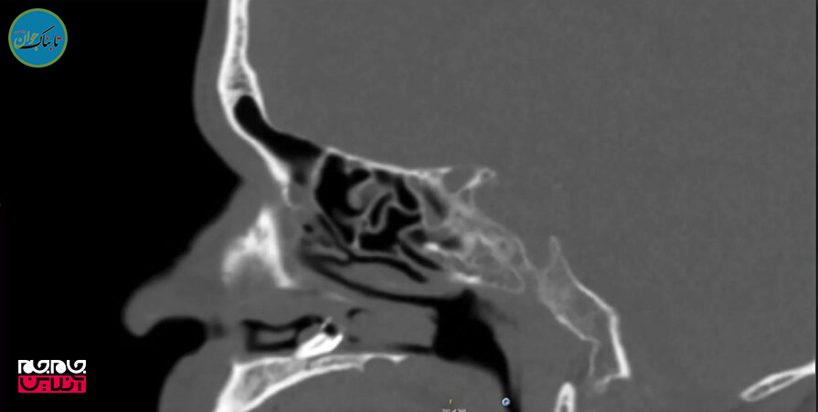 دماغ یک مرد دانمارکی دندان درآورد! (+تصاویر)