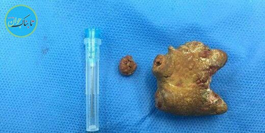 خروج یک کیلو سنگ از مثانه دختر ۱۸ ساله