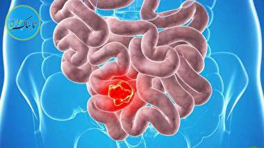 بسته خبری:درمان سرطان روده با ورزش!