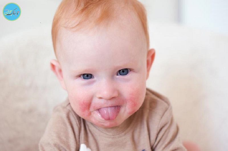 آلرژی بهاره از کجا می‌آید؟