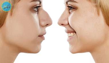 بسته خبری : داشتن بینی زیبا بدون عمل جراحی + فیلم