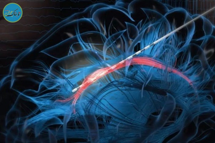 ایجاد خنده در بیمار، حین عمل جراحی مغز