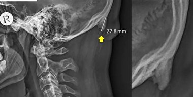 «اسکلت» پوشیدنی در راه است