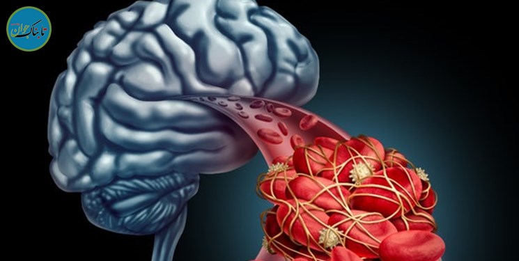 تحمل بهتر آلزایمربا تحصیلات دانشگاهی