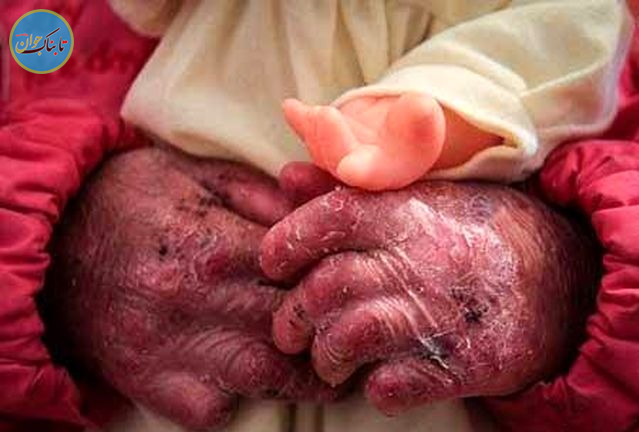 اعلام جنگ به سرطان با اختراع آقای ۷۵ ساله