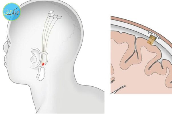 ارتباط انسان و ماشین با کاشت تراشه در مغز