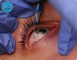 جزئیات جدید از ماجرای مرموز نابینایی ۵٢ نفر با داروی اوستین