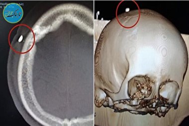 یک دندان در جمجمه نوجوان پرتغالی!