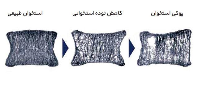 پوکی استخوان