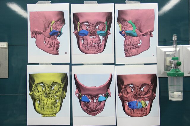 بازسازی صورت بیمار در بیمارستان شریعتی