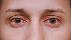 علل قرمز شدن چشم‌ها چیست؟