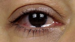 اشک چشم منتقل کننده ویروس کرونا