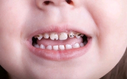 علت سیاه شدن دندان کودکان چیست؟