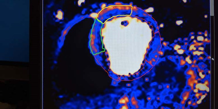 امکان پیش بینی خطر ابتلای کرونایی ها به بیماری های قلبی با هوش مصنوعی