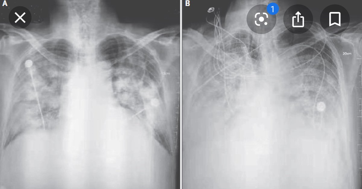 اسکن قفسه سینه