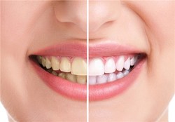 ۱۰ راز برای داشتن دندان‌های سفیدتر و درخشان‌تر