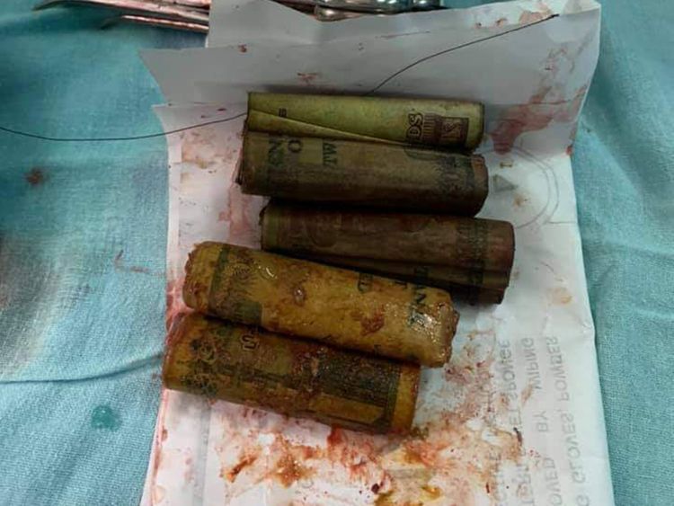 محتویات غیرمنتظره‌ای که پزشکان از معده بیمار خارج کردند + عکس