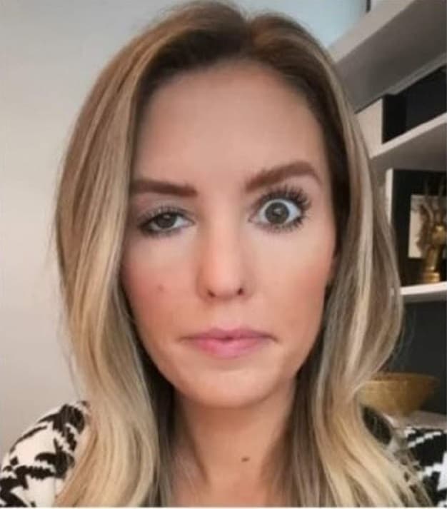 بلایی که بوتاکس بر سر یک اینفلوئنسر اینستاگرام آورد