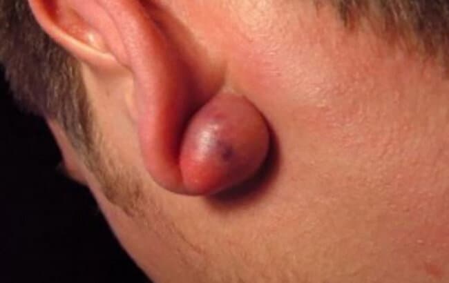 عوارض پیرسینگ