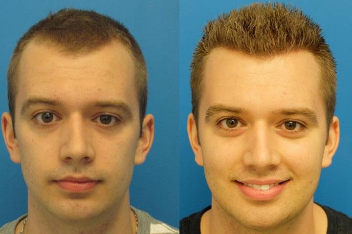 انواع روش های کاشت مو + مزایا و معایب