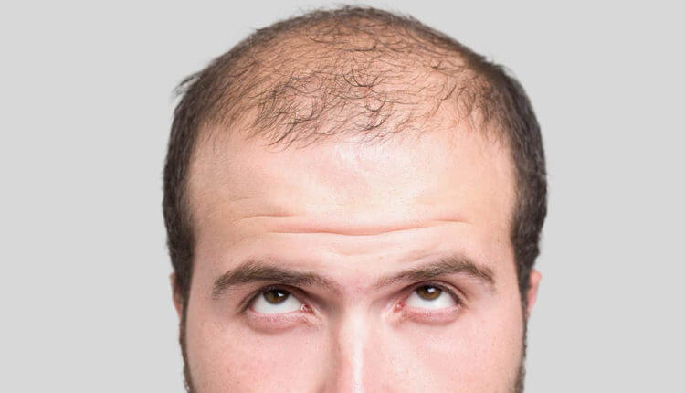 انواع روش های کاشت مو