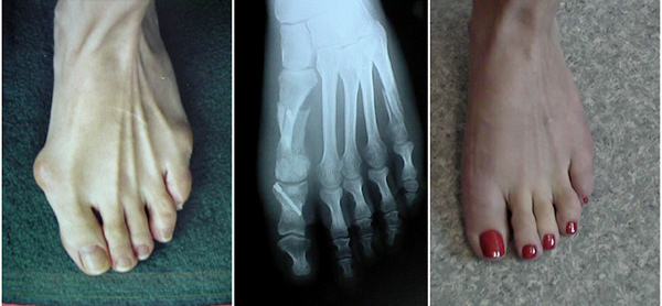 چه درمان هایی در مراحل اولیه هالوکس والگوس موثر هستند؟