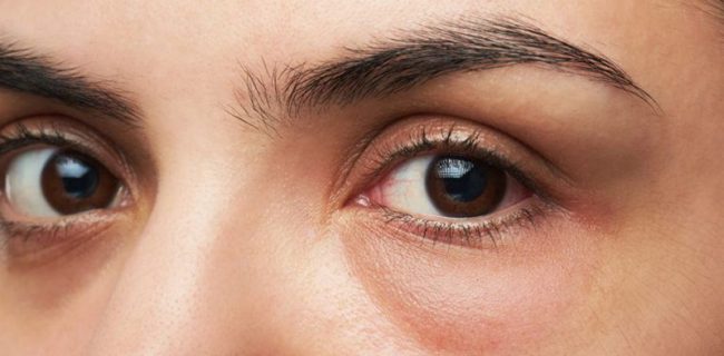 تشخیص عصبی بودن افراد در چشم ها