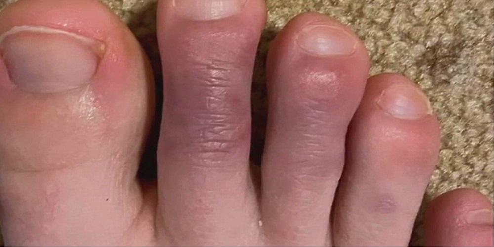 انگشت پا کوویدی چیست؟
