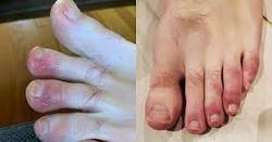 بیماری انگشت پا کوویدی چیست؟