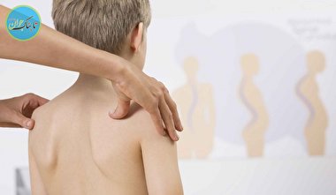 علت اسکولیوز چیست و چند نوع دارد؟