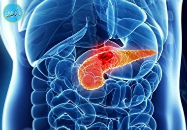 سرطان پانکراس چیست؟ علت، علائم و درمان