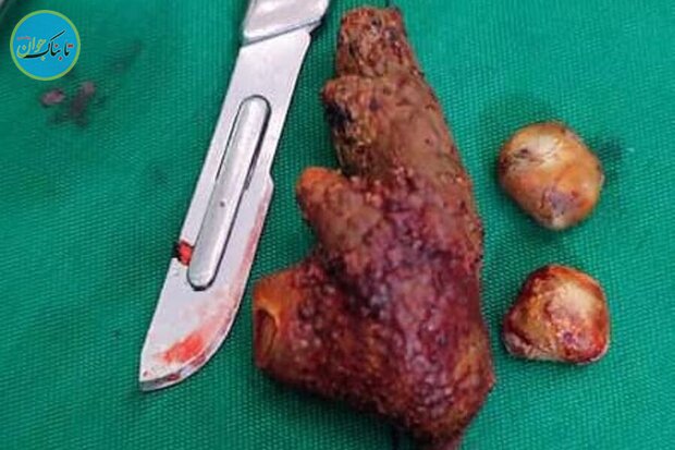 کشف عجیب از کلیه یک بیمار در گناوه