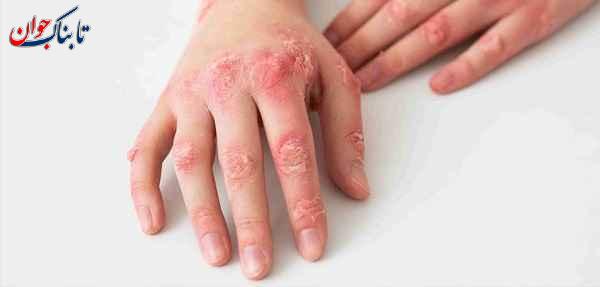 آیا زونا واگیر دارد؟