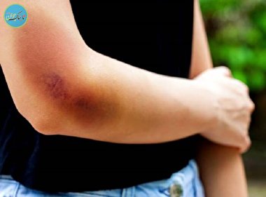 هماتوم چیست؟ (در بارداری، مردان و زنان)