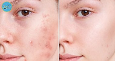 چطور جوش های صورت را از بین ببریم؟