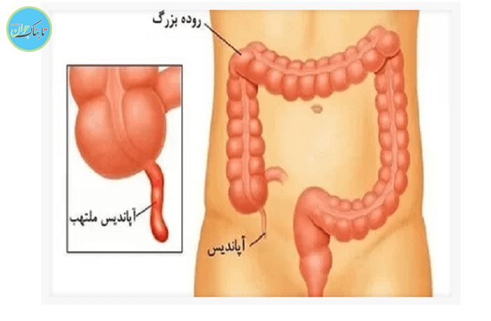 آپاندیس کدام سمت بدن است؟ + علائم ترکیدن