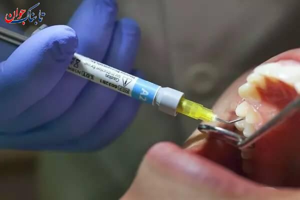 لمینت دندان چیست؟ فرق آن با کامپوزیت؛ کدام بهتر است؟