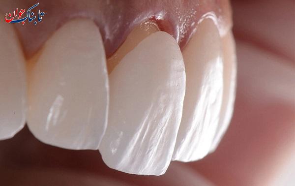 لمینت دندان چیست؟ فرق آن با کامپوزیت؛ کدام بهتر است؟