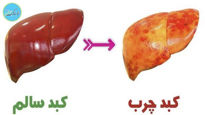 عکس کبد چرب و کبد سالم