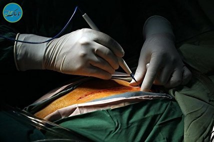 لیپوساکشن چیست؟ / علت مرگ پس از لیپوساکشن!