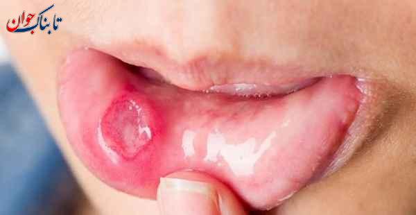 علت آفت دهان چیست؟ + درمان سریع در خانه